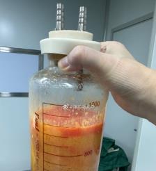 哈密水动力吸脂手术要做多久？